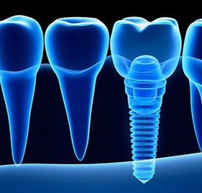 Dental Implant Crowns & Bridges