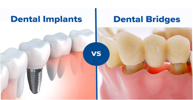 Full Mouth Restoration Dental Implants & Dental Bridges