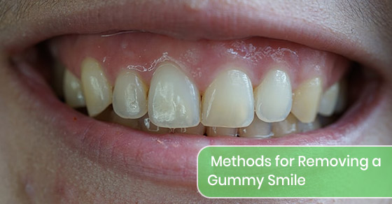 What are the methods for removing a gummy smile?