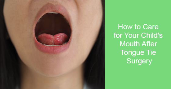 How to Care for Your Child's Mouth After Tongue Tie Surgery
