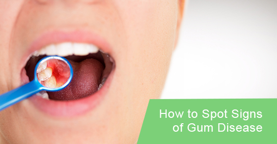 How to spot signs of gum disease