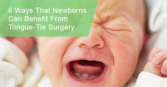 Ways that newborns can benefit from tongue-tie surgery