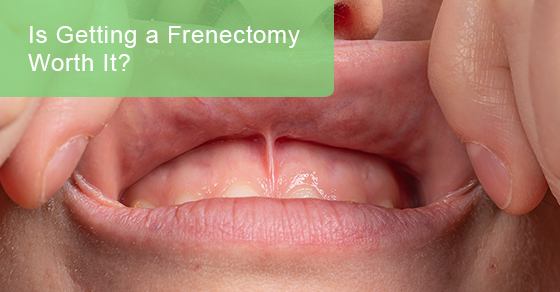 Is getting a frenectomy worth it?