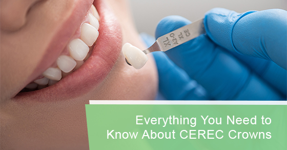 Everything you need to know about CEREC crowns