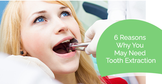 Reasons why you may need tooth extraction