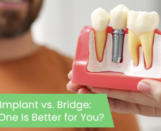 Dental implant vs. Bridge: Which one is better for you?