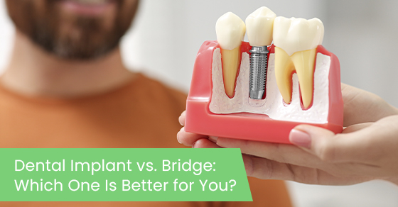 Dental implant vs. Bridge: Which one is better for you?