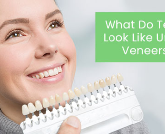 What do teeth look like under veneers?